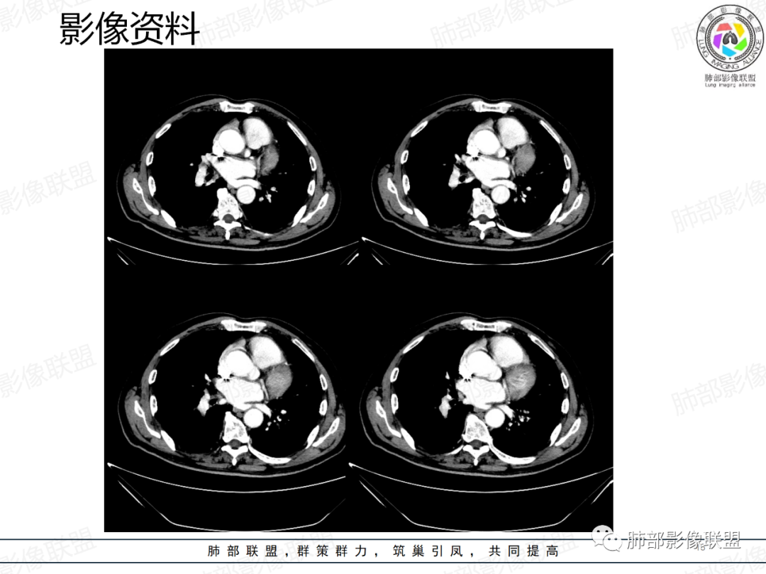 影像PPT - 【病例】一例囊腔性病变诊断思路与鉴别要点-13 影像PPT - 【病例】一例囊腔性病变诊断思路与鉴别要点-13