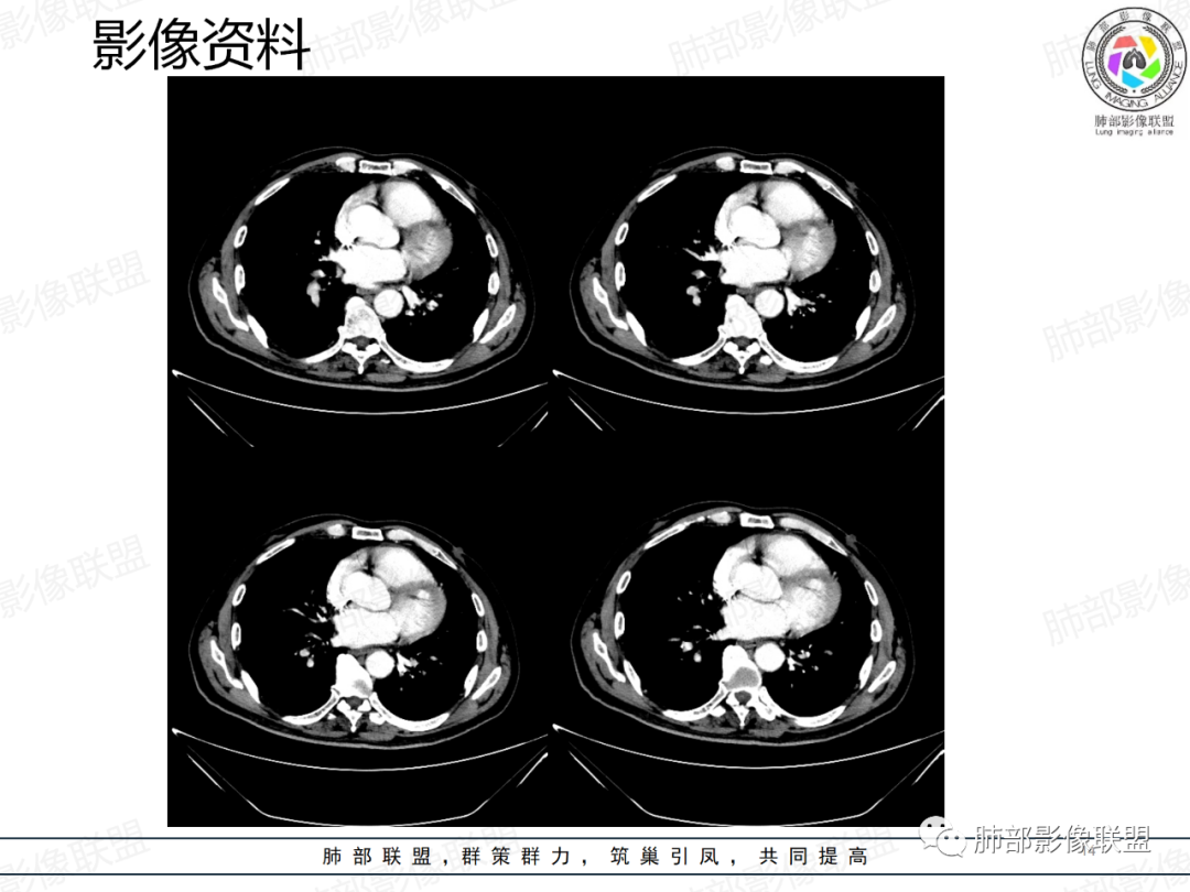 影像PPT - 【病例】一例囊腔性病变诊断思路与鉴别要点-14 影像PPT - 【病例】一例囊腔性病变诊断思路与鉴别要点-14