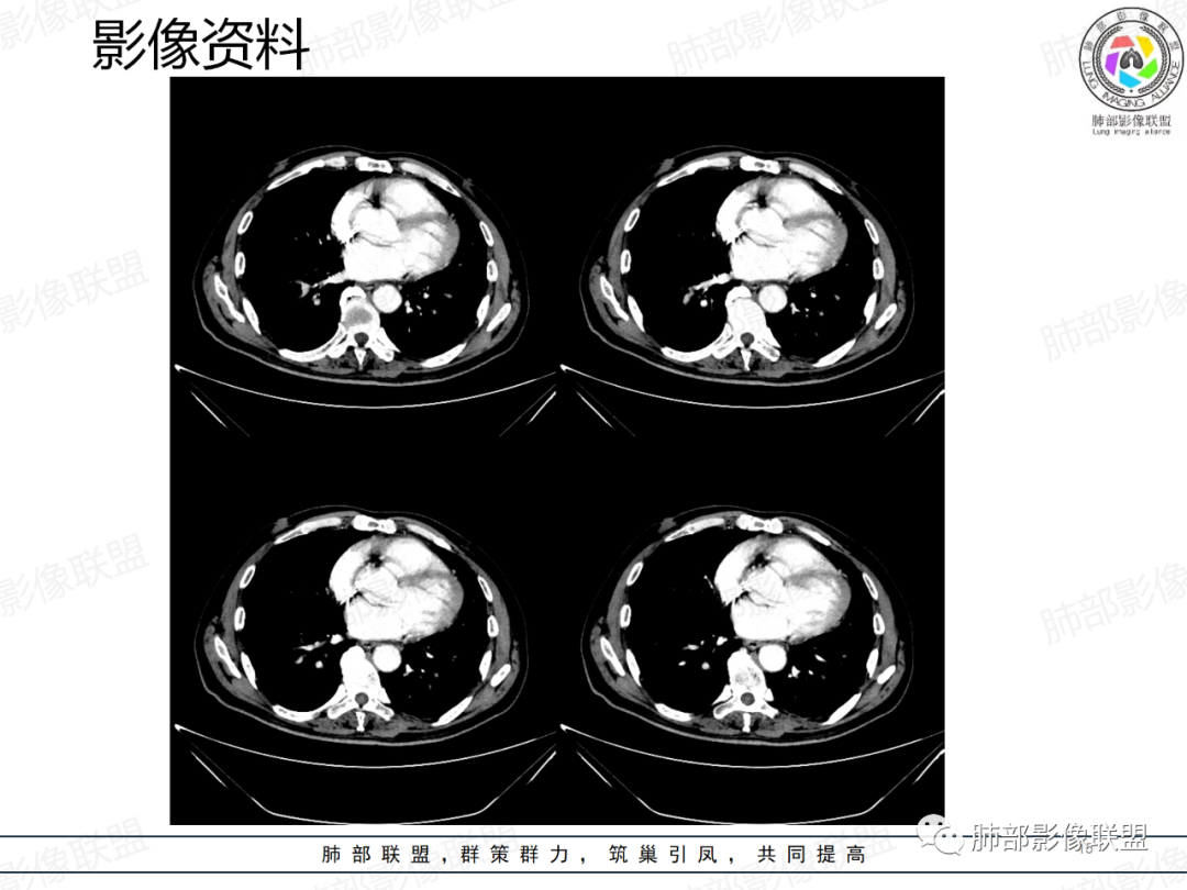 影像PPT - 【病例】一例囊腔性病变诊断思路与鉴别要点-15 影像PPT - 【病例】一例囊腔性病变诊断思路与鉴别要点-15