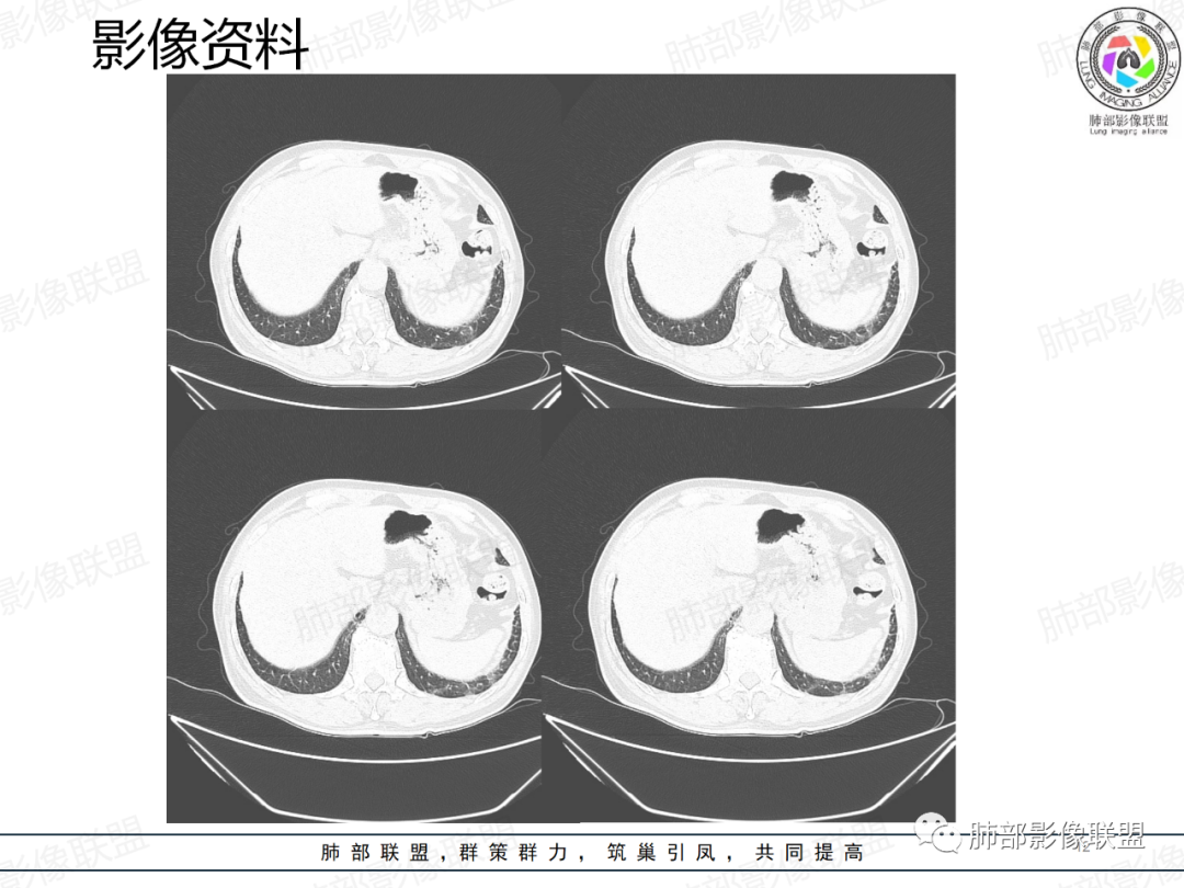 影像PPT - 【病例】一例囊腔性病变诊断思路与鉴别要点-12 影像PPT - 【病例】一例囊腔性病变诊断思路与鉴别要点-12