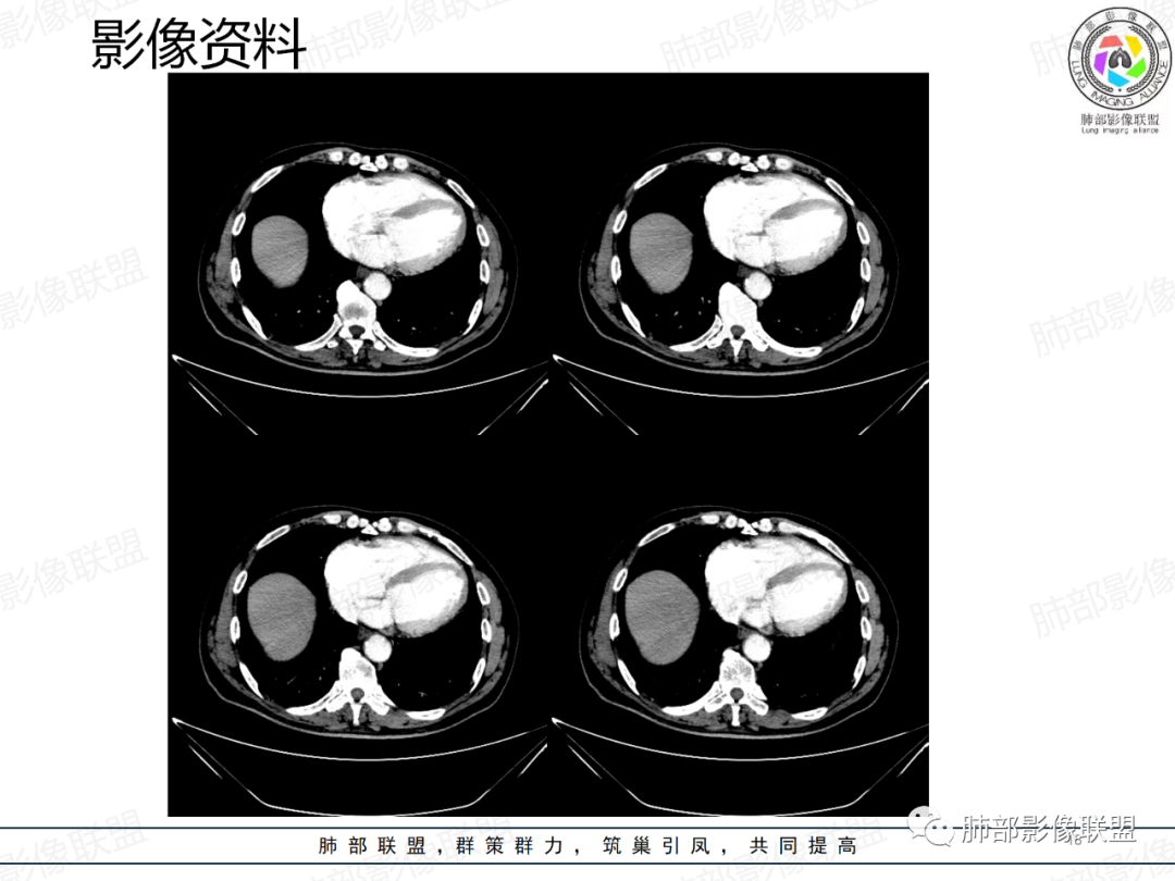 影像PPT - 【病例】一例囊腔性病变诊断思路与鉴别要点-18 影像PPT - 【病例】一例囊腔性病变诊断思路与鉴别要点-18