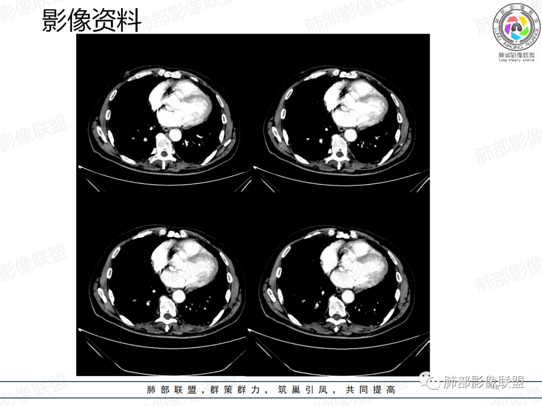 影像PPT - 【病例】一例囊腔性病变诊断思路与鉴别要点-16 影像PPT - 【病例】一例囊腔性病变诊断思路与鉴别要点-16