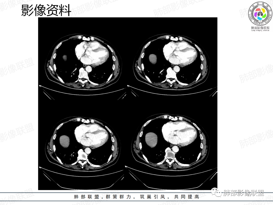影像PPT - 【病例】一例囊腔性病变诊断思路与鉴别要点-17 影像PPT - 【病例】一例囊腔性病变诊断思路与鉴别要点-17