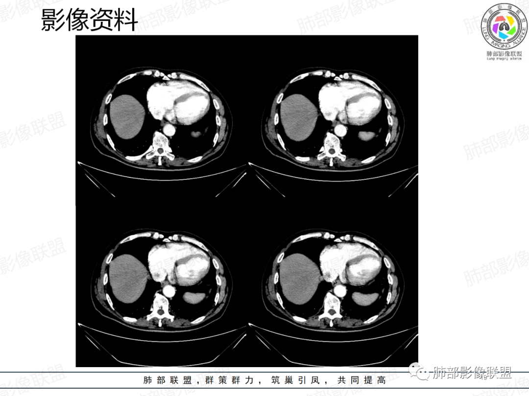 影像PPT - 【病例】一例囊腔性病变诊断思路与鉴别要点-19 影像PPT - 【病例】一例囊腔性病变诊断思路与鉴别要点-19
