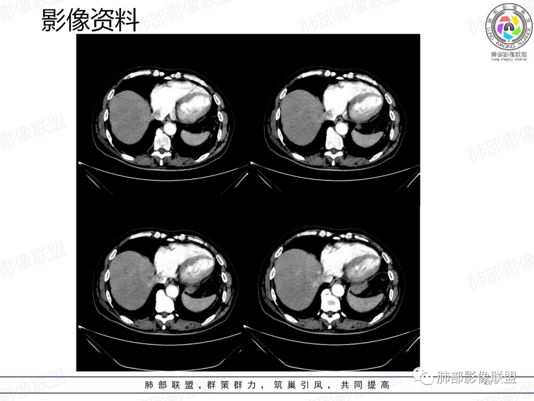影像PPT - 【病例】一例囊腔性病变诊断思路与鉴别要点-20 影像PPT - 【病例】一例囊腔性病变诊断思路与鉴别要点-20