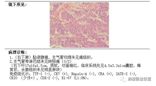 影像PPT - 【病例】一例囊腔性病变诊断思路与鉴别要点-24 影像PPT - 【病例】一例囊腔性病变诊断思路与鉴别要点-24
