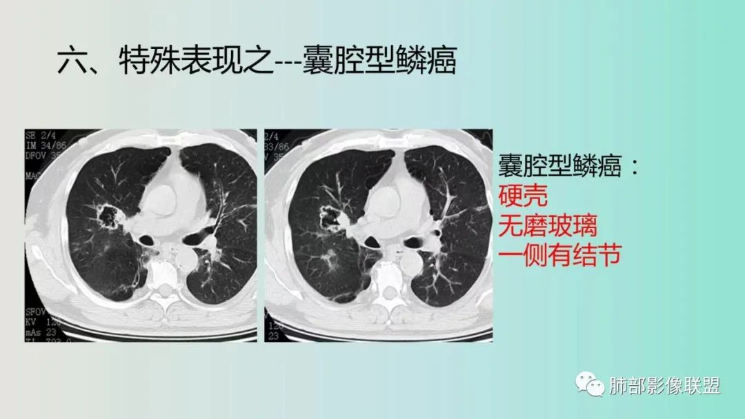 影像PPT - 【病例】一例囊腔性病变诊断思路与鉴别要点-25 影像PPT - 【病例】一例囊腔性病变诊断思路与鉴别要点-25