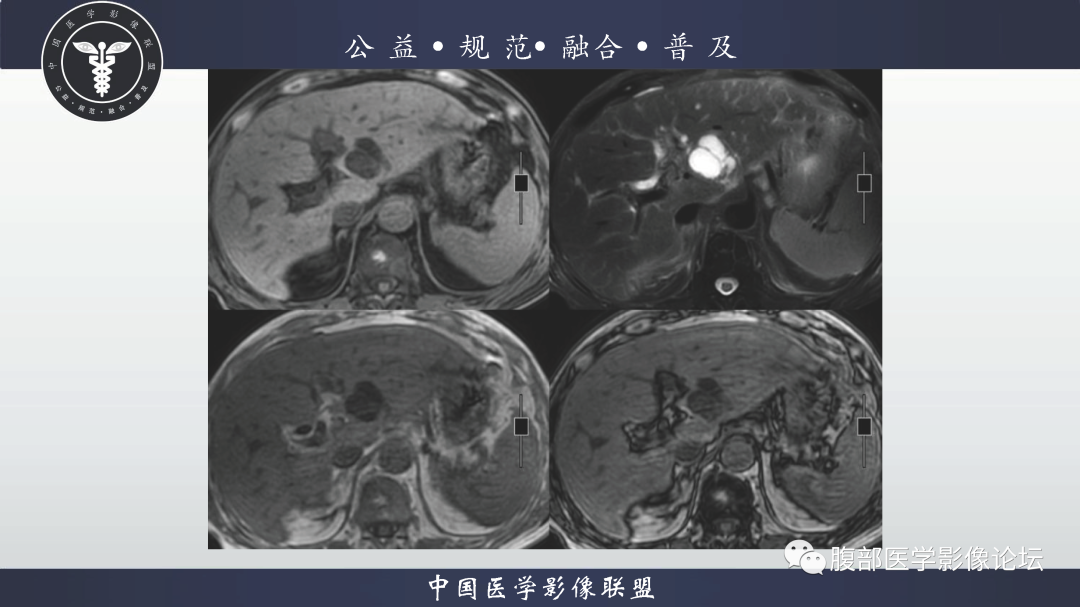 影像PPT - 【病例】肝脏胆管内乳头状肿瘤1例CT及MR-3