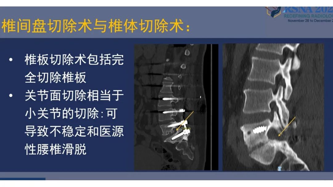 影像PPT - 【PPT】术后脊柱-为了外科医生和患者安全着想的金属图像-11