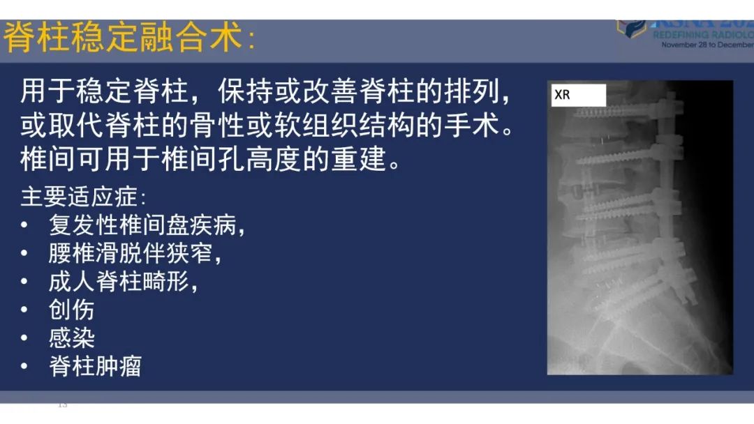 影像PPT - 【PPT】术后脊柱-为了外科医生和患者安全着想的金属图像-13