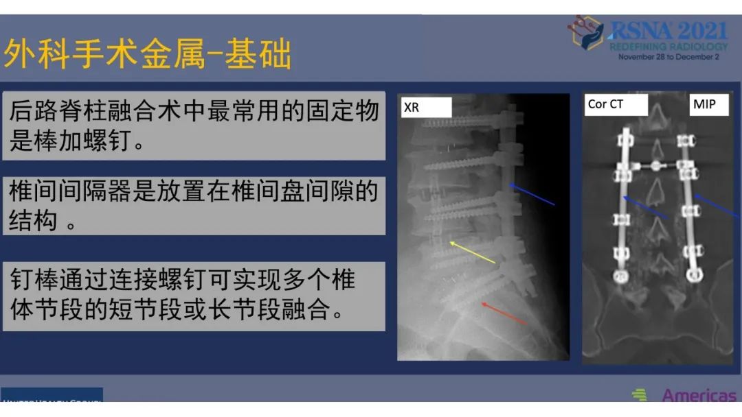 影像PPT - 【PPT】术后脊柱-为了外科医生和患者安全着想的金属图像-15