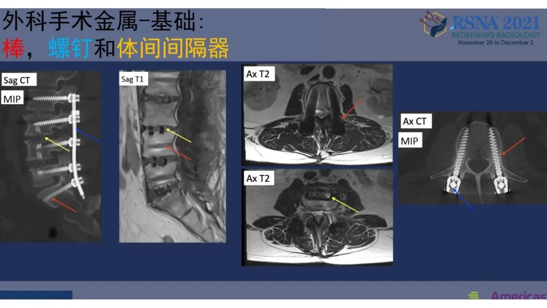 影像PPT - 【PPT】术后脊柱-为了外科医生和患者安全着想的金属图像-17