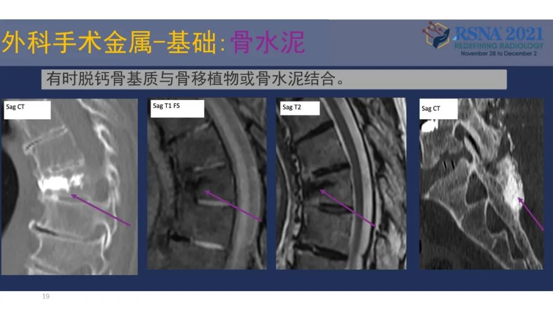 影像PPT - 【PPT】术后脊柱-为了外科医生和患者安全着想的金属图像-19