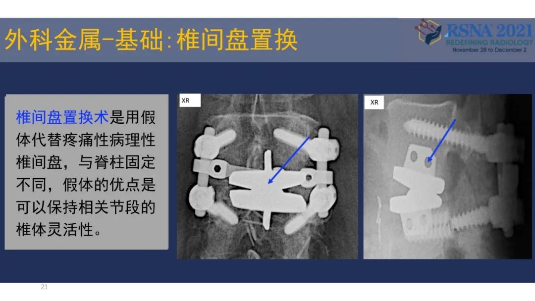 影像PPT - 【PPT】术后脊柱-为了外科医生和患者安全着想的金属图像-21