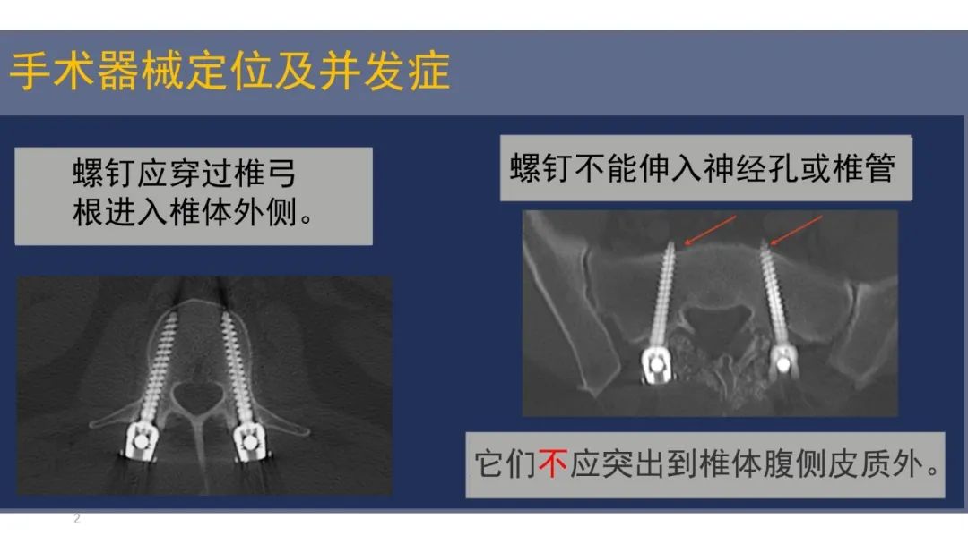 影像PPT - 【PPT】术后脊柱-为了外科医生和患者安全着想的金属图像-25