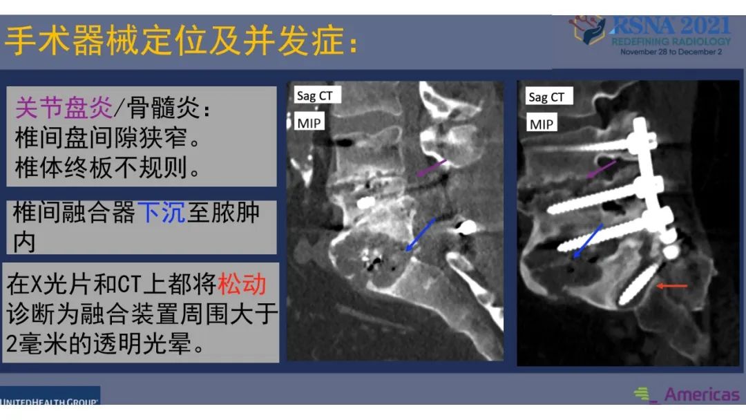 影像PPT - 【PPT】术后脊柱-为了外科医生和患者安全着想的金属图像-31