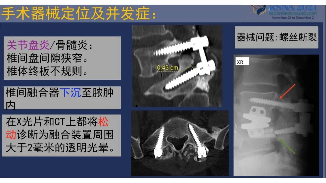 影像PPT - 【PPT】术后脊柱-为了外科医生和患者安全着想的金属图像-33