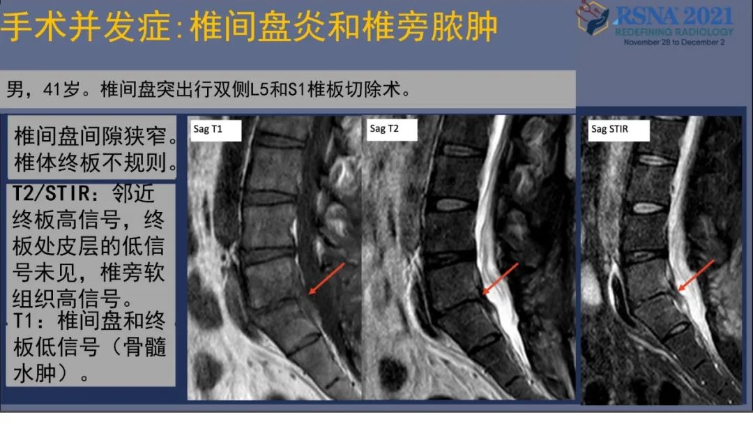 影像PPT - 【PPT】术后脊柱-为了外科医生和患者安全着想的金属图像-37