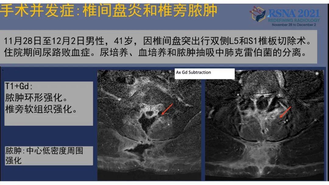 影像PPT - 【PPT】术后脊柱-为了外科医生和患者安全着想的金属图像-39