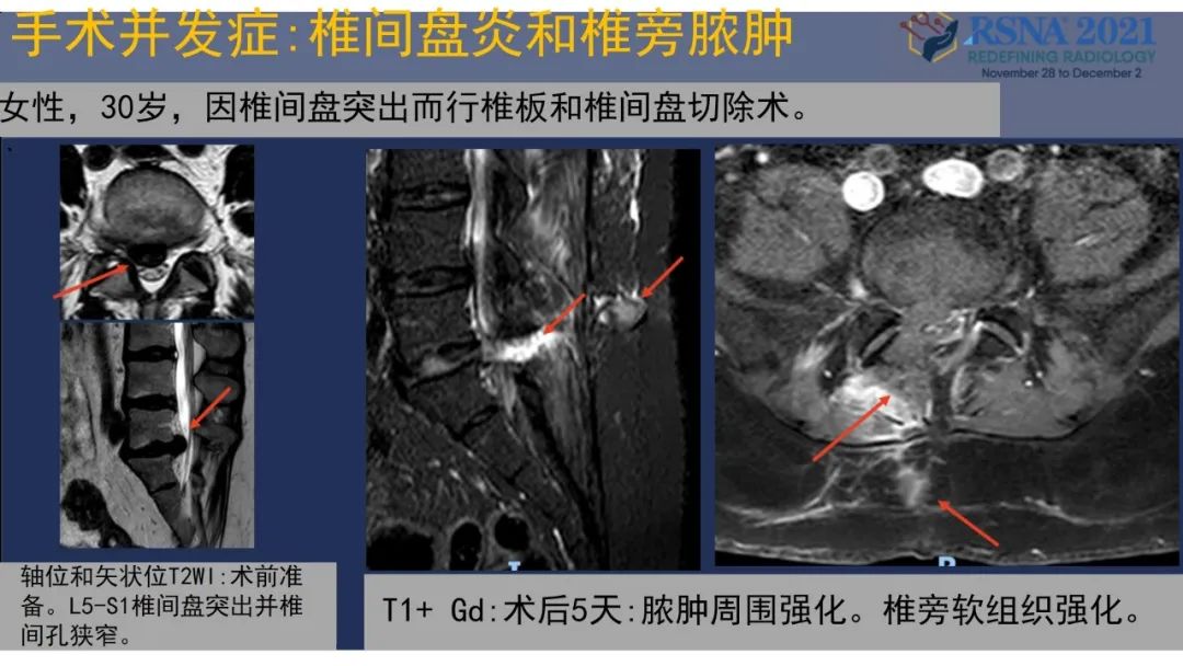 影像PPT - 【PPT】术后脊柱-为了外科医生和患者安全着想的金属图像-41
