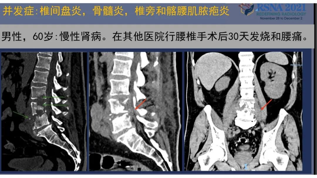 影像PPT - 【PPT】术后脊柱-为了外科医生和患者安全着想的金属图像-43