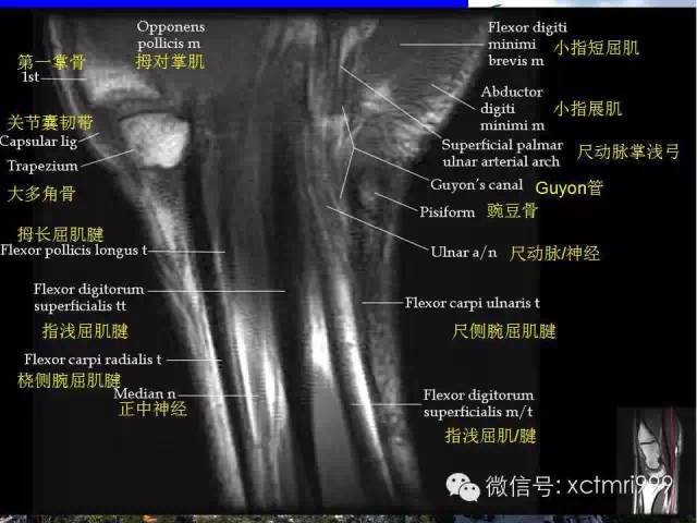 影像PPT - 【PPT】腕关节MRI解剖中英对照-5