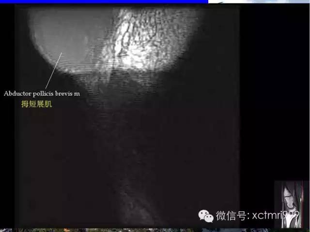 影像PPT - 【PPT】腕关节MRI解剖中英对照-3