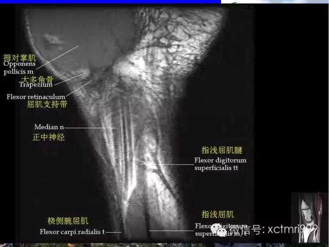 影像PPT - 【PPT】腕关节MRI解剖中英对照-4