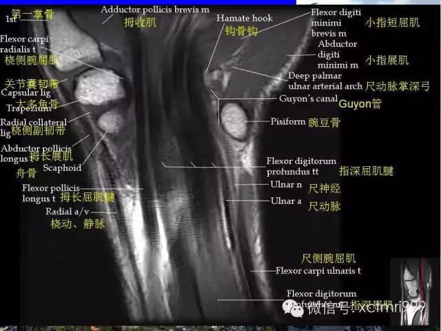影像PPT - 【PPT】腕关节MRI解剖中英对照-6