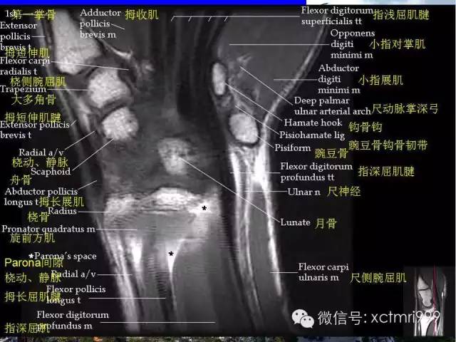 影像PPT - 【PPT】腕关节MRI解剖中英对照-7