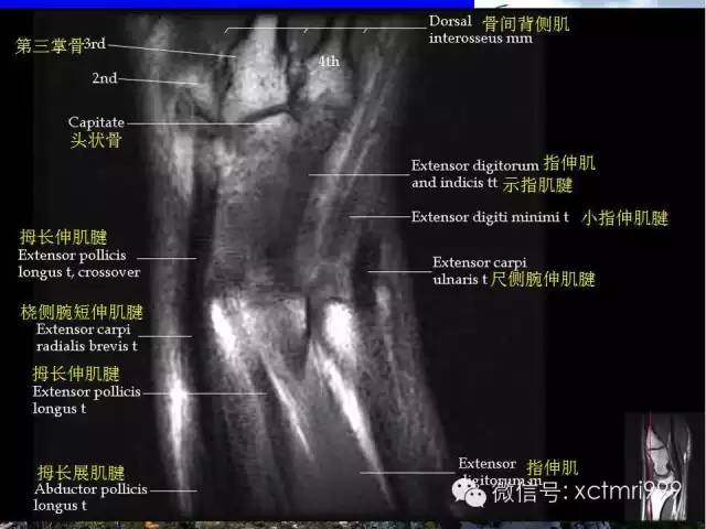 影像PPT - 【PPT】腕关节MRI解剖中英对照-12
