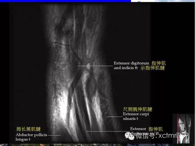 影像PPT - 【PPT】腕关节MRI解剖中英对照-13