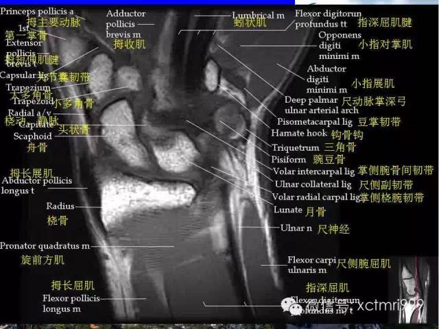 影像PPT - 【PPT】腕关节MRI解剖中英对照-8