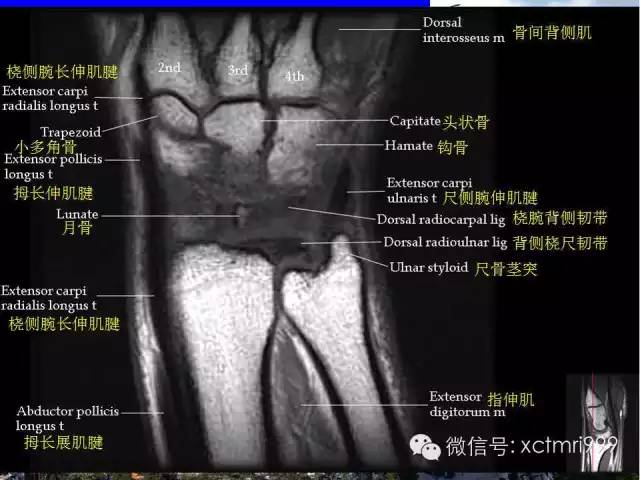 影像PPT - 【PPT】腕关节MRI解剖中英对照-11