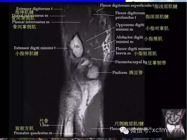 影像PPT - 【PPT】腕关节MRI解剖中英对照-16