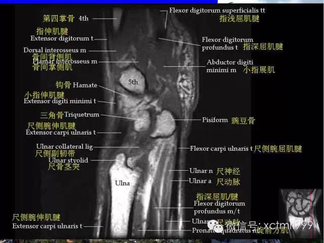 影像PPT - 【PPT】腕关节MRI解剖中英对照-17