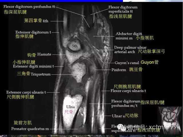 影像PPT - 【PPT】腕关节MRI解剖中英对照-18