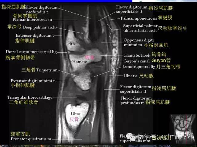 影像PPT - 【PPT】腕关节MRI解剖中英对照-19