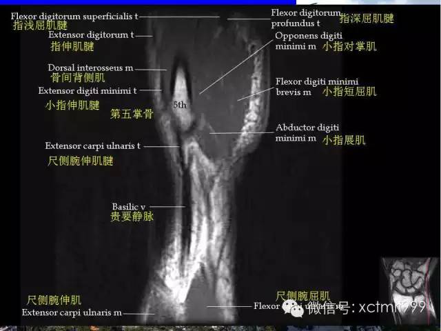 影像PPT - 【PPT】腕关节MRI解剖中英对照-15