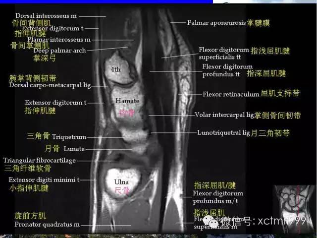 影像PPT - 【PPT】腕关节MRI解剖中英对照-20