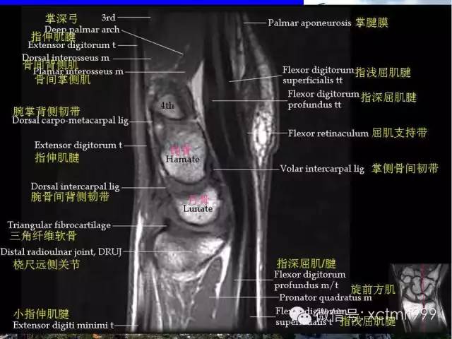 影像PPT - 【PPT】腕关节MRI解剖中英对照-21