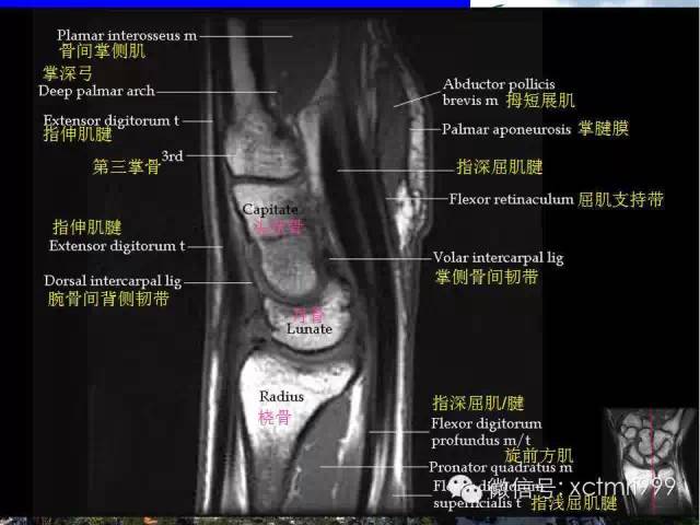 影像PPT - 【PPT】腕关节MRI解剖中英对照-22