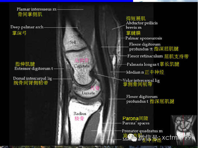 影像PPT - 【PPT】腕关节MRI解剖中英对照-23