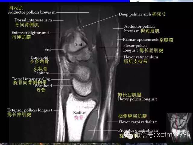 影像PPT - 【PPT】腕关节MRI解剖中英对照-25