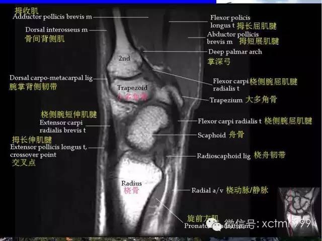影像PPT - 【PPT】腕关节MRI解剖中英对照-26