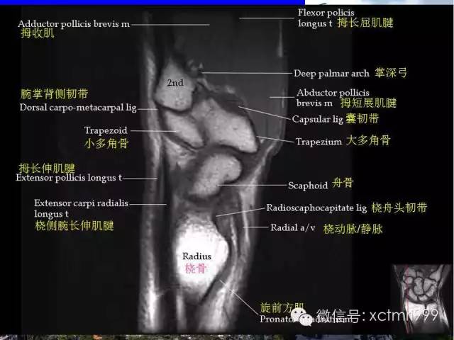 影像PPT - 【PPT】腕关节MRI解剖中英对照-27