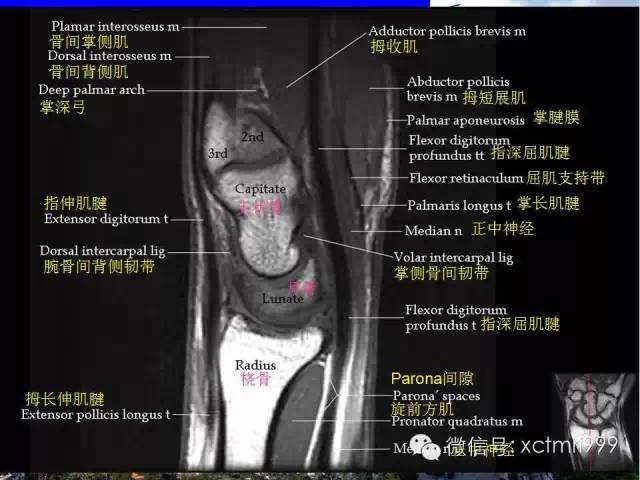 影像PPT - 【PPT】腕关节MRI解剖中英对照-24