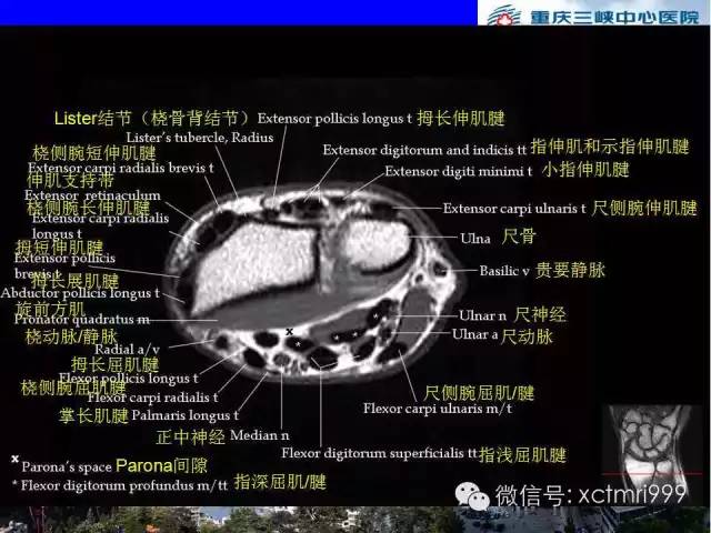影像PPT - 【PPT】腕关节MRI解剖中英对照-32