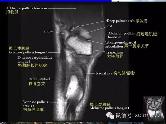 影像PPT - 【PPT】腕关节MRI解剖中英对照-28