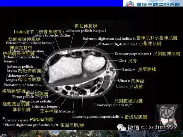 影像PPT - 【PPT】腕关节MRI解剖中英对照-33